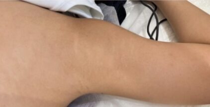 scar-after-1