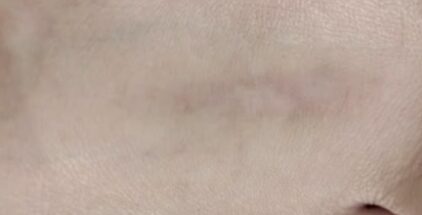 scar-after-2