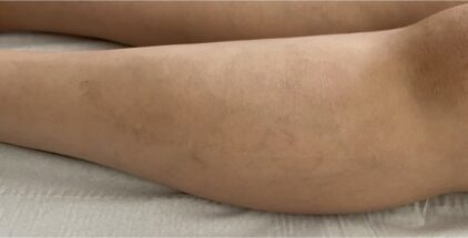 scar-after-6