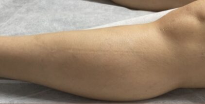scar-before-6
